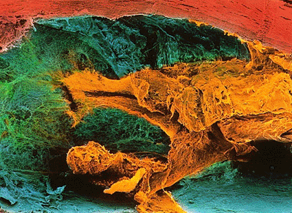 Imagen: Microfotografía electrónica de barrido (SEM) a color de un corte a través de una arteria coronaria humana que muestra una placa ateroesclerótica (Fotografía cortesía de los Profs. P.M. Motta, G. Macchiarelli, S.A. Nottola / SPL). Imagen: Microfotografía electrónica de barrido (SEM) a color de un corte a través de una arteria coronaria humana que muestra una placa ateroesclerótica (Fotografía cortesía de los Profs. P.M. Motta, G. Macchiarelli, S.A. Nottola / SPL).